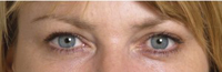 Botox correctong Crow´s Feet